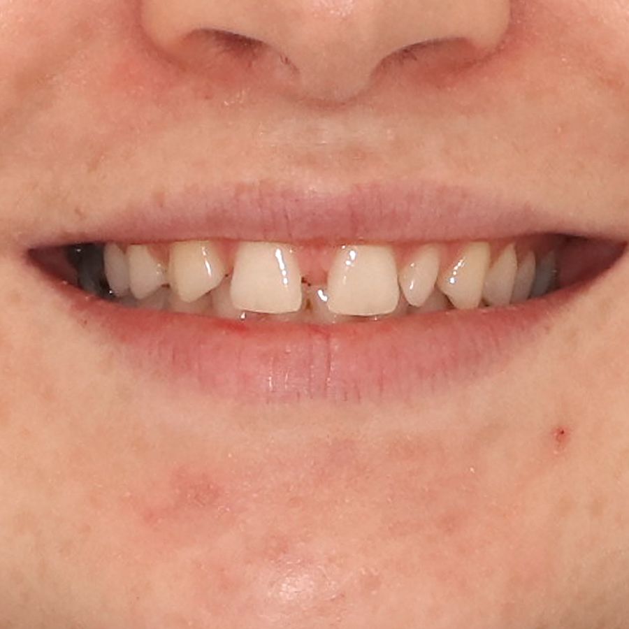 porcelain veneers before 3Dental